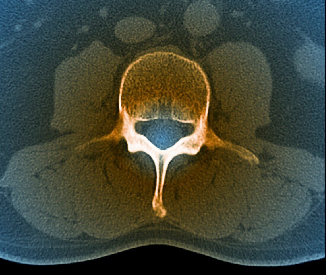 Lumbar vertebra,CT scan