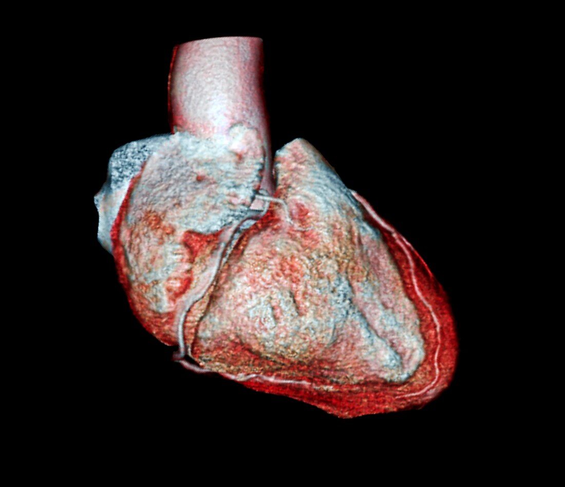 Coronary arteries,CT scan