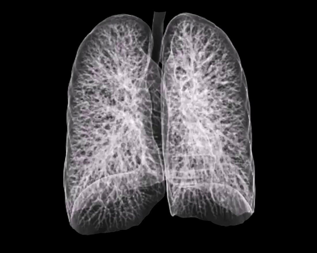 Healthy lungs,CT scan