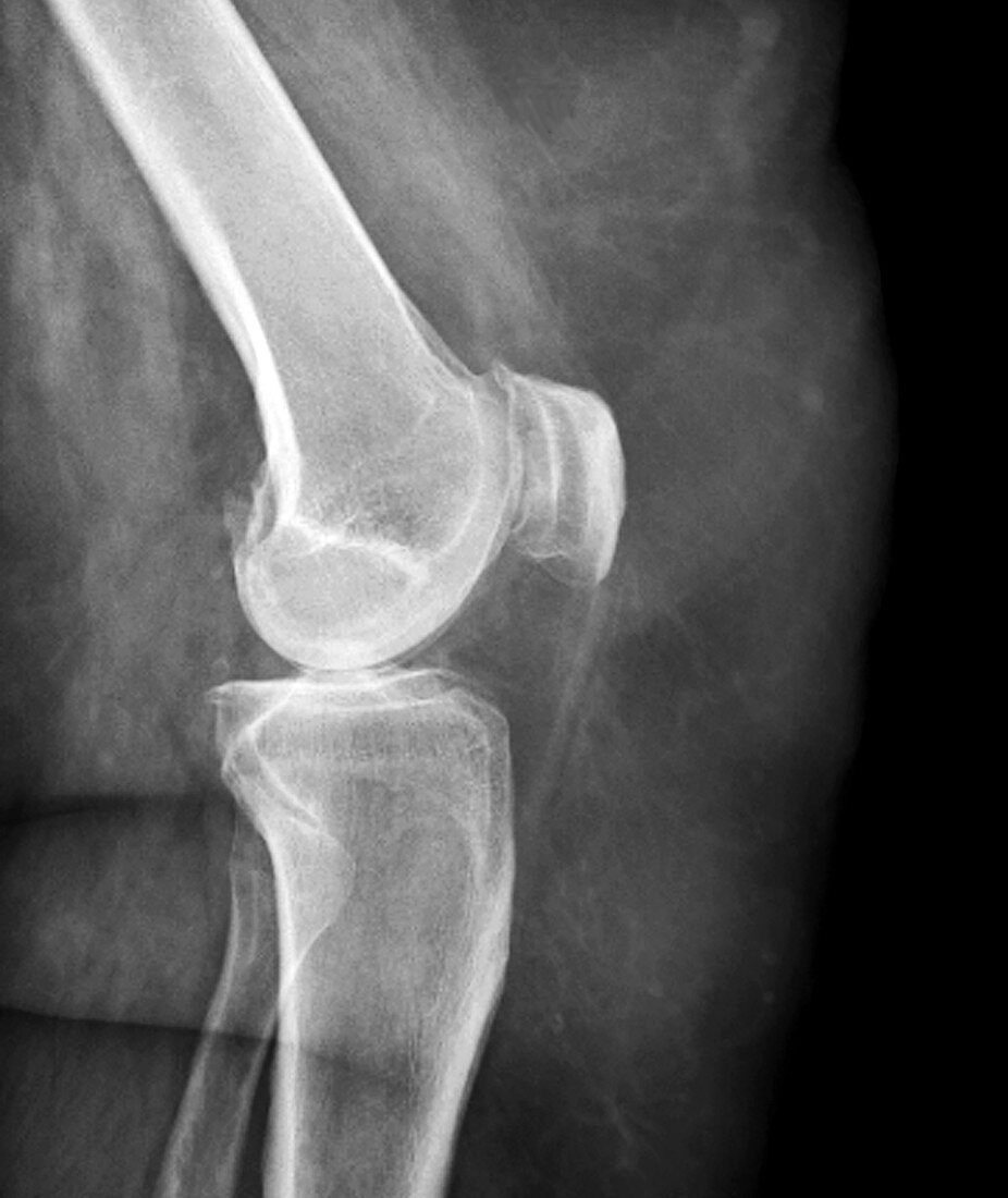 Arthritis of the knee,X-ray