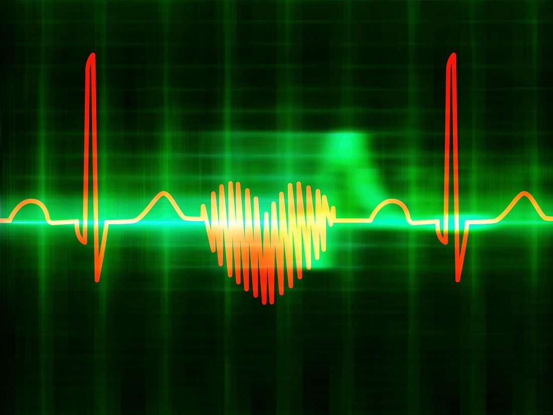 Heart-shaped ECG trace