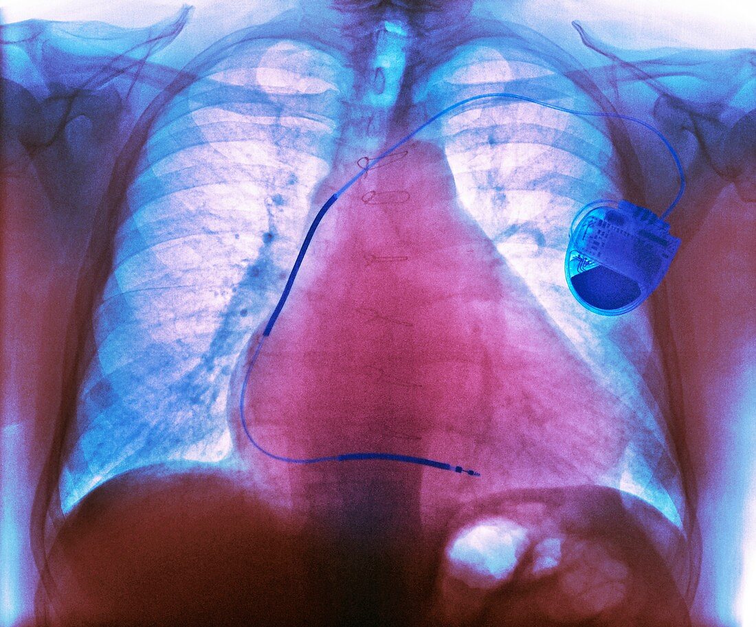 Pacemaker in heart disease,X-ray