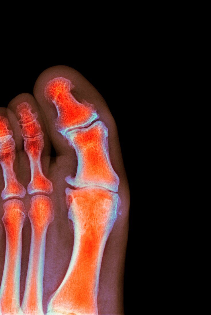 Degenerative foot deformation,X-ray