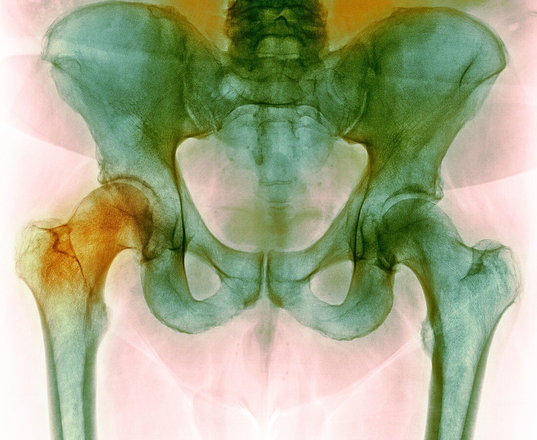 Hip before hip replacement surgery,X-ray