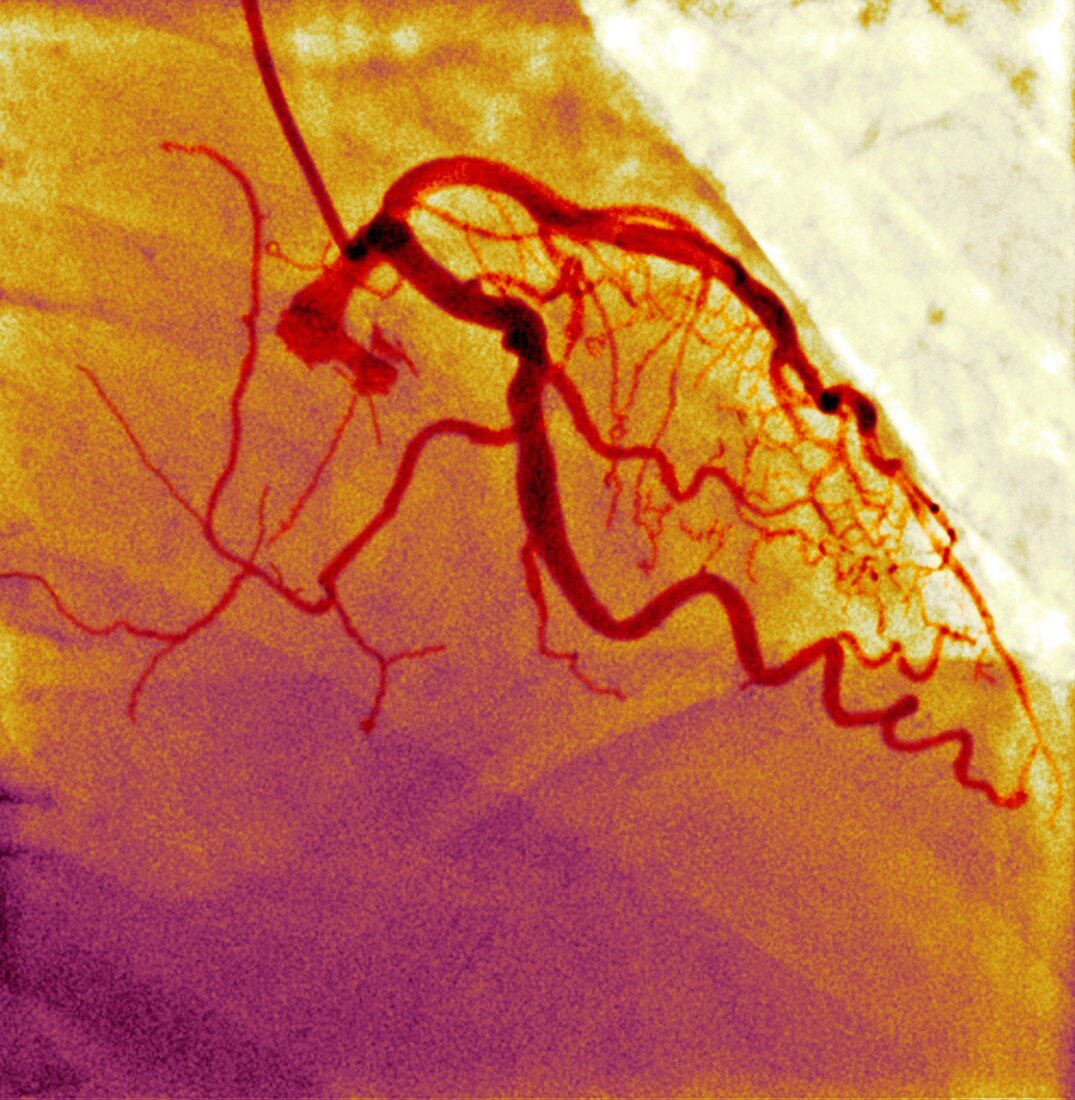 Normal blood vessels,X-ray