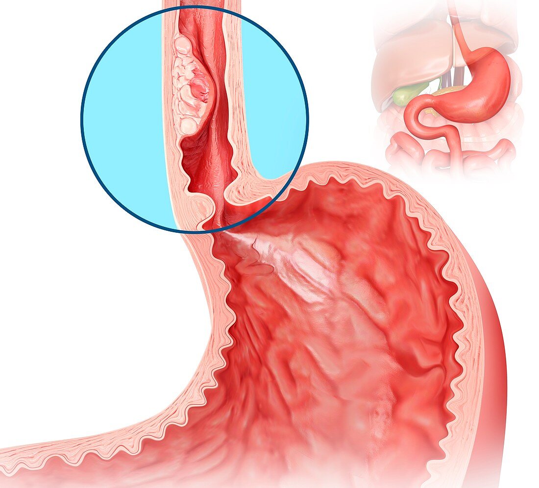 Oesophageal cancer,illustration