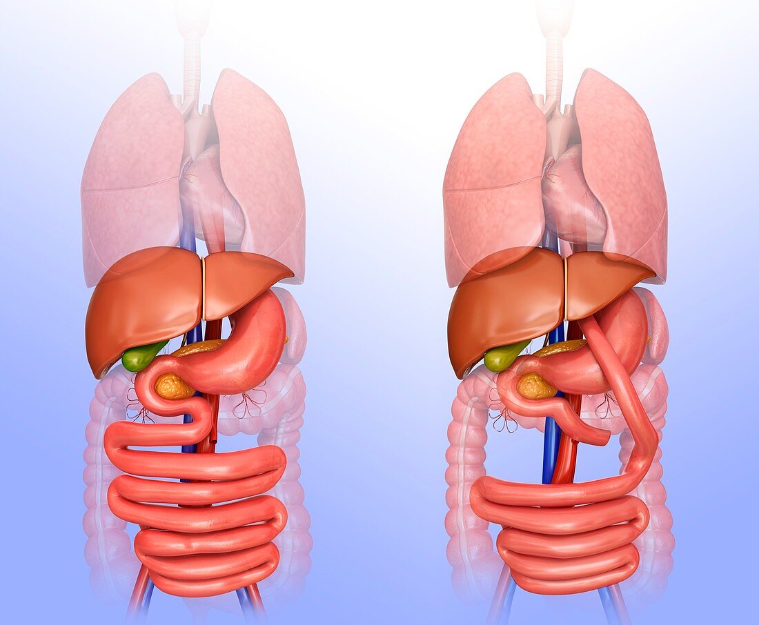 Gastric bypass,illustration