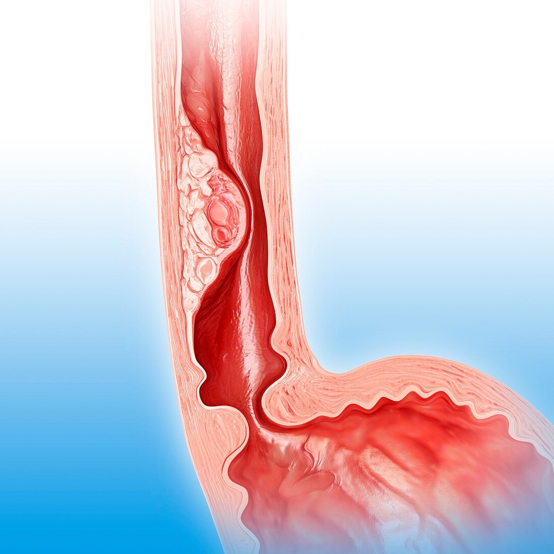 Oesophageal cancer,illustration