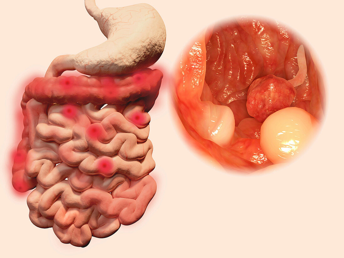 Intestinal polyps,illustration