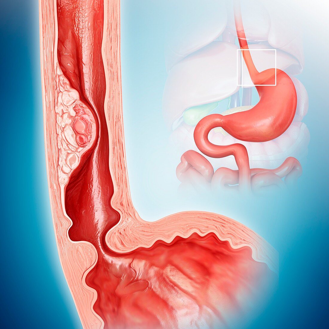 Oesophageal cancer,illustration