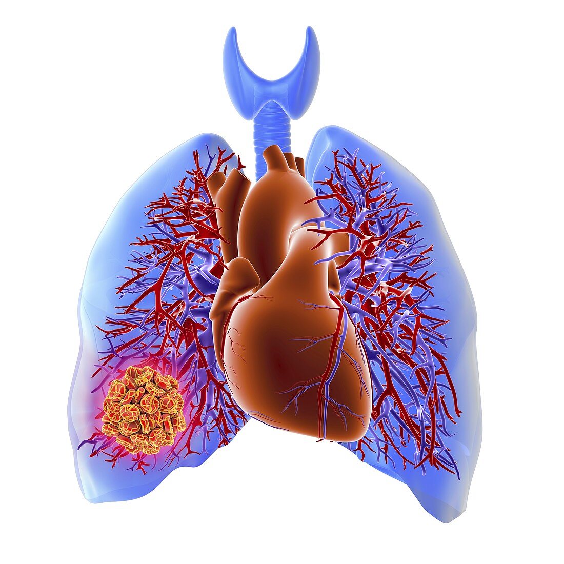 Pulmonary embolism,artwork