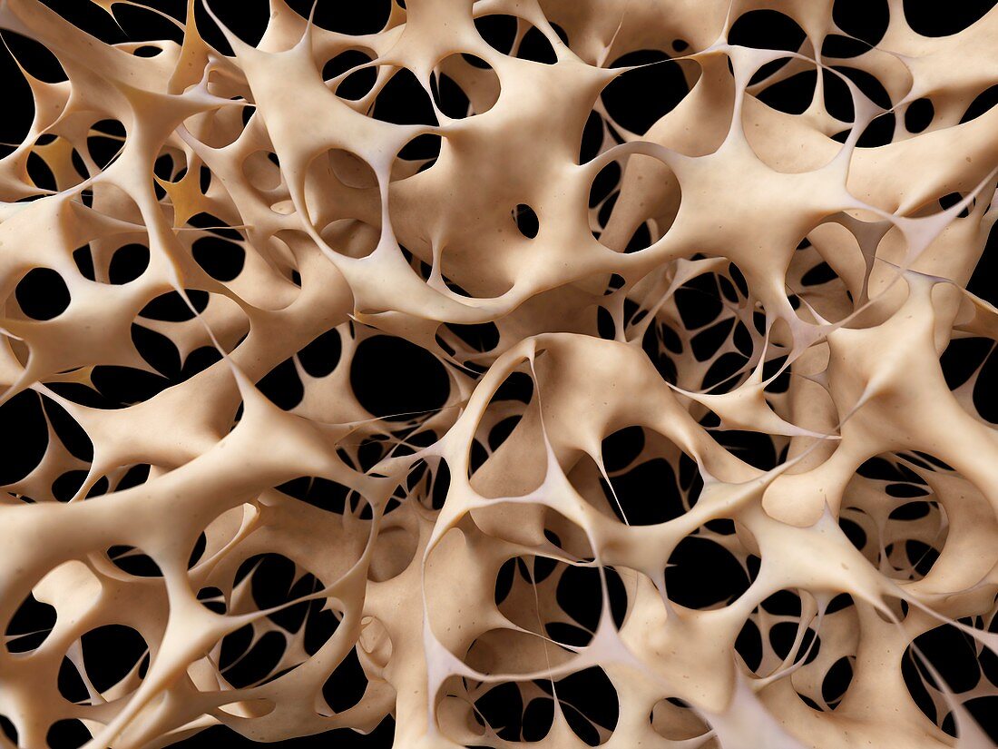 Bones with osteoporosis,illustration
