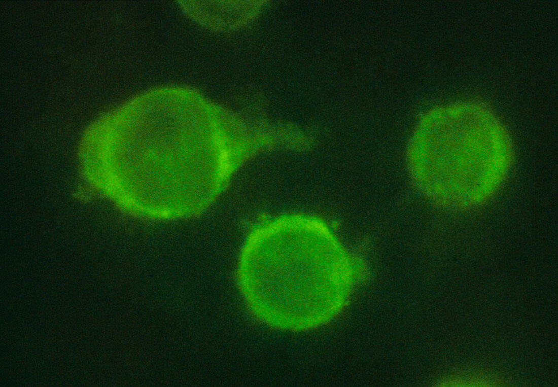 Human monoclonal antibodies staining glioma cells