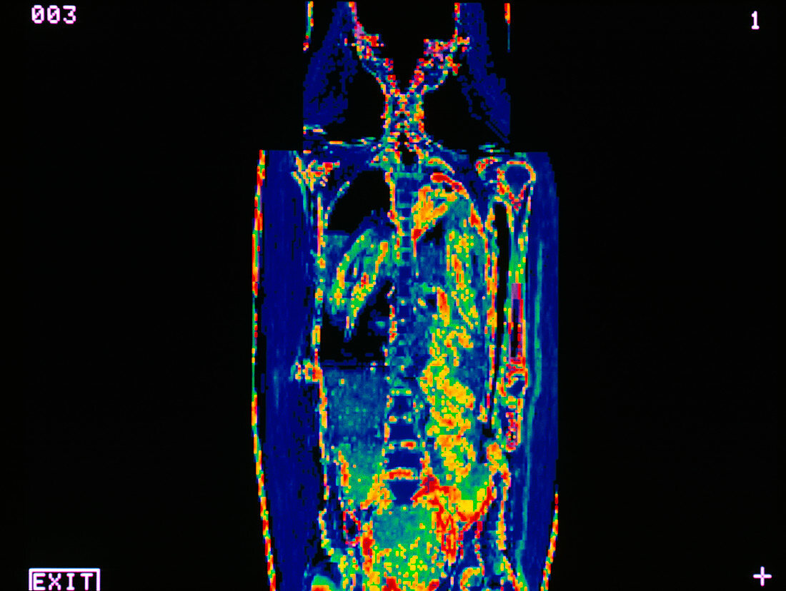 Coronal CT scan of head/torso of Egyptian mummy