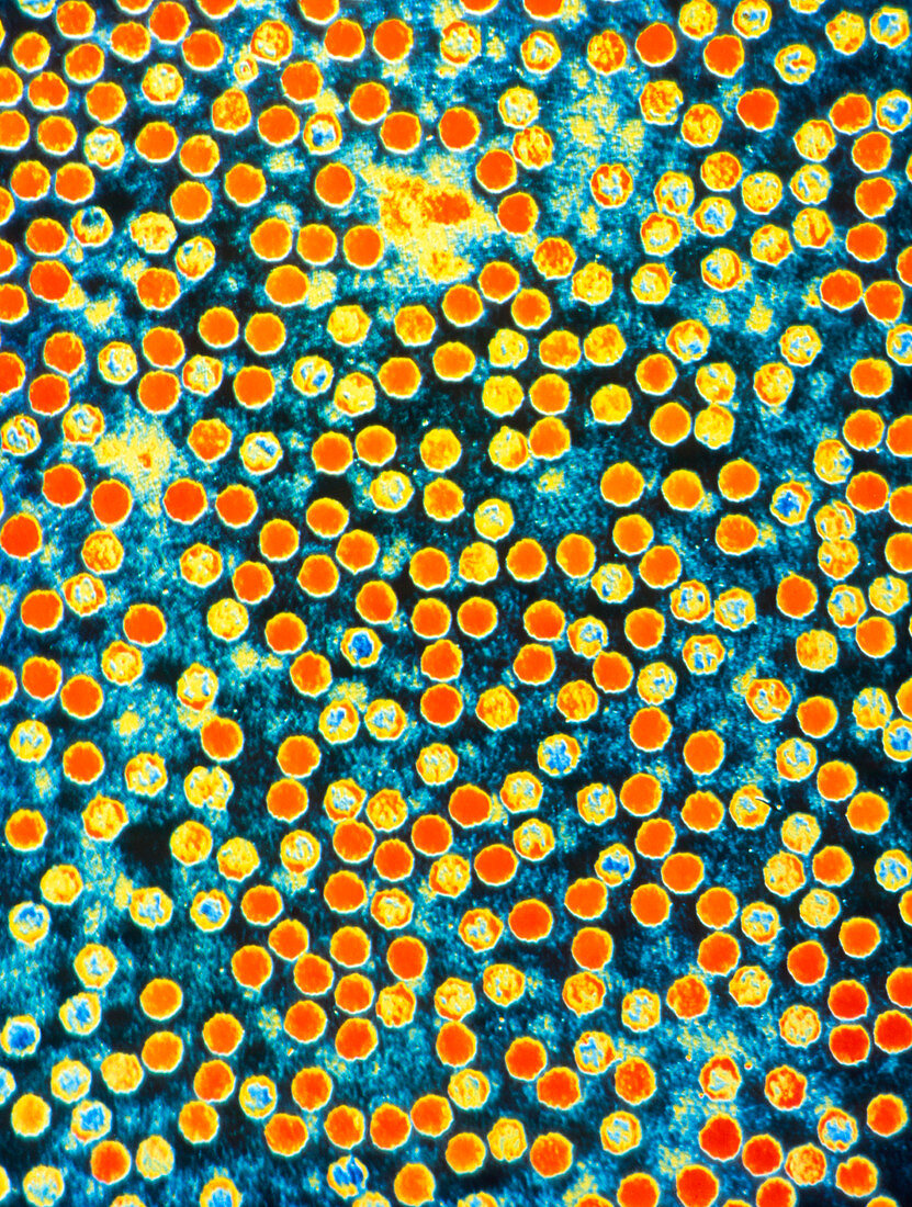 Coloured TEM of polio virus virions