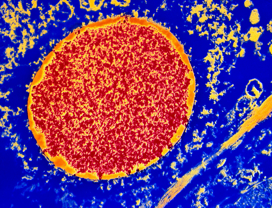 Coloured TEM of cell in measles encephalitis