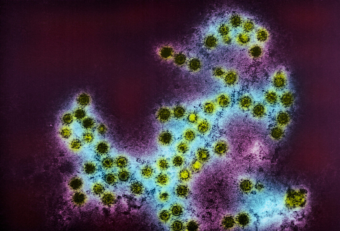 Coloured TEM of a group of Coxsackie viruses
