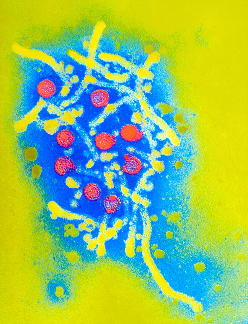 Coloured TEM of hepatitis B virus & its antigen