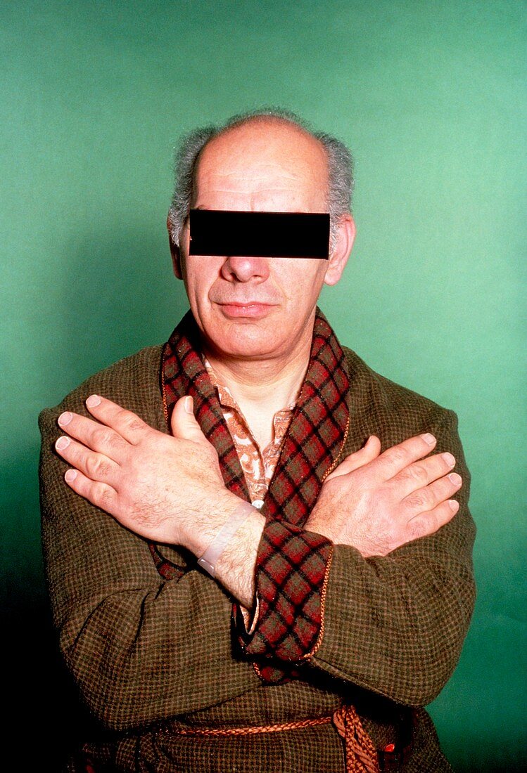 Clinical photo of man suffering from acromegaly