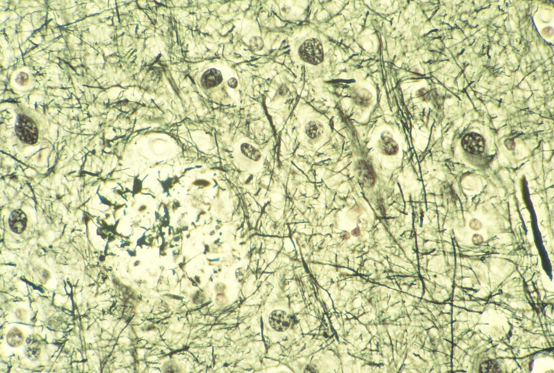 LM of brain in Alzheimer's disease - senile plaque