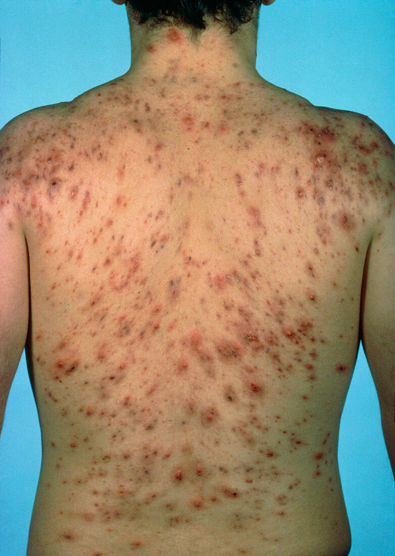 Acne vulgaris: scarring over a man's back