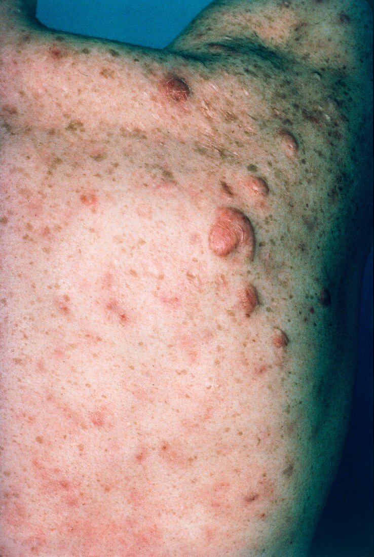 Acne vulgaris: keloid scars on a man's shoulder