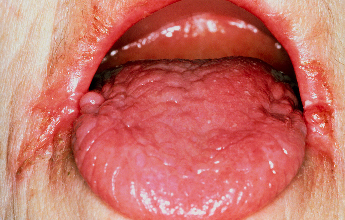 Red tongue in anaemia