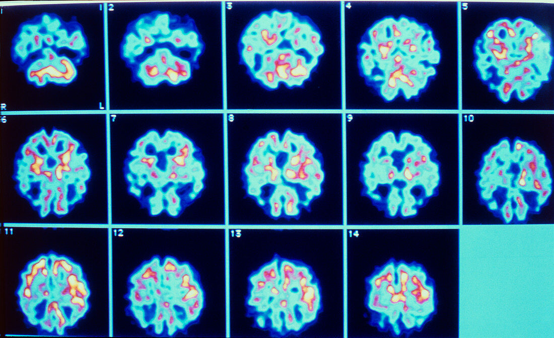 PET scan series of Alzheimer's disease
