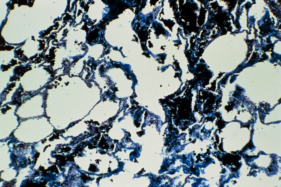 LM of lung tissue containing coal particles