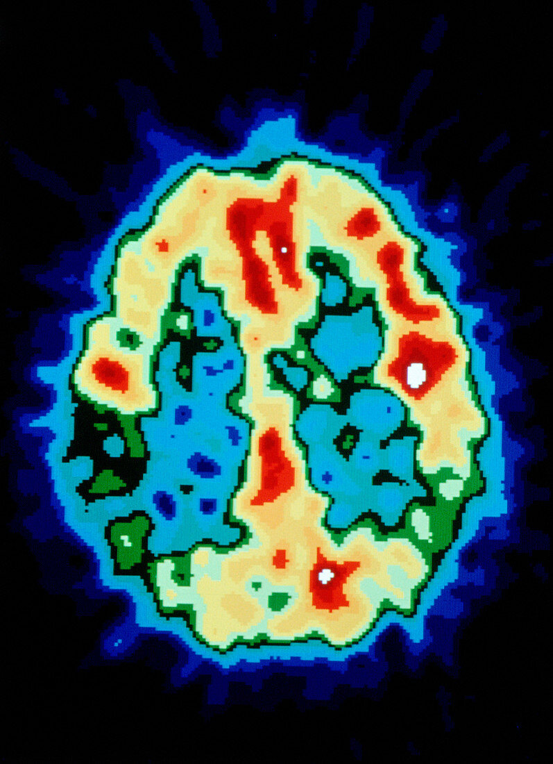 PET brain scan: Alzheimer's disease