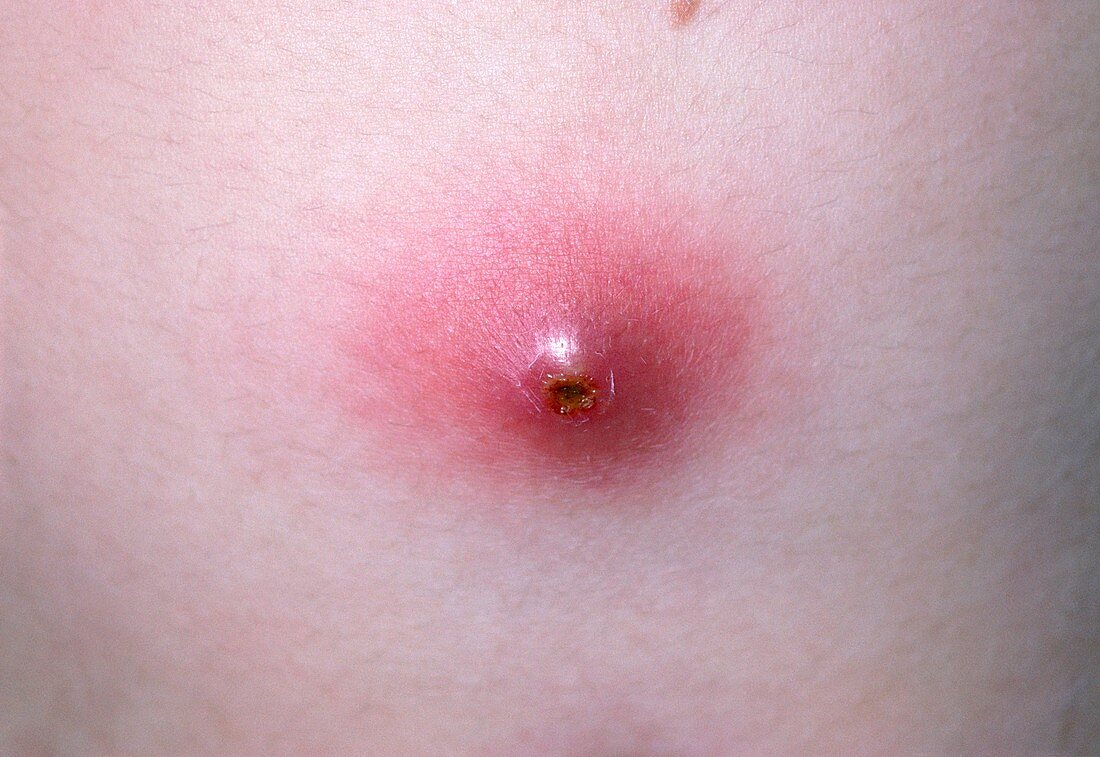 Abscess on the abdomen of a 7 year old girl