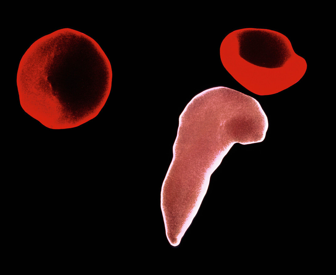 Coloured SEM of blood in sickle cell anaemia