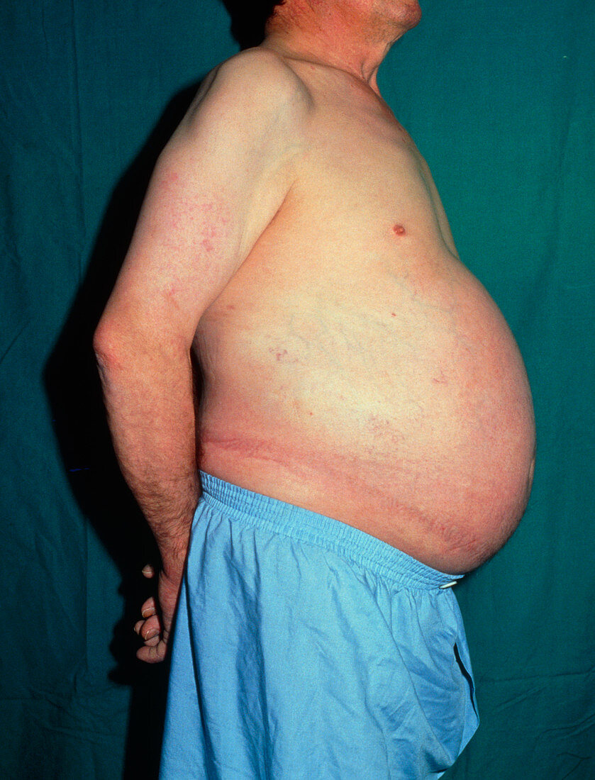 Ascites: side view of distended abdomen