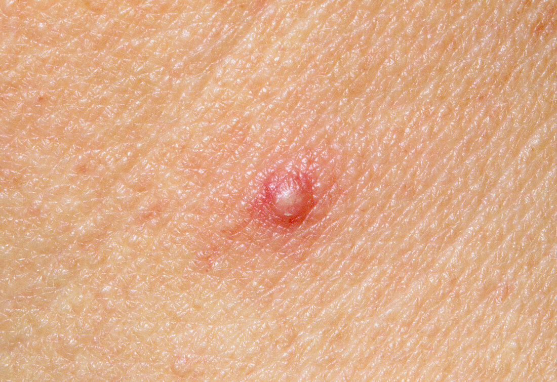 Close-up of acne vulgaris spot on skin