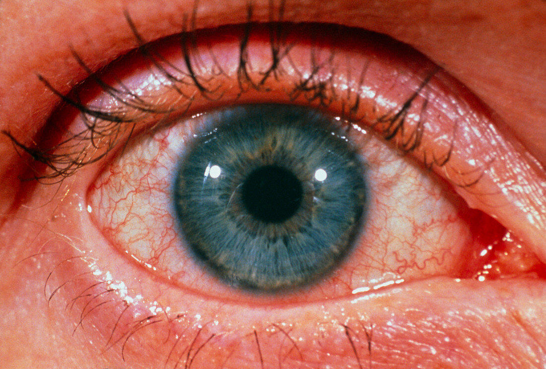 Simulated eye test for Alzheimer's: pre- eyedrops