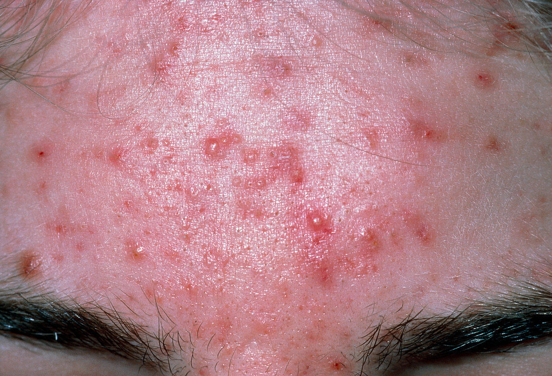 Acne vulgaris on forehead