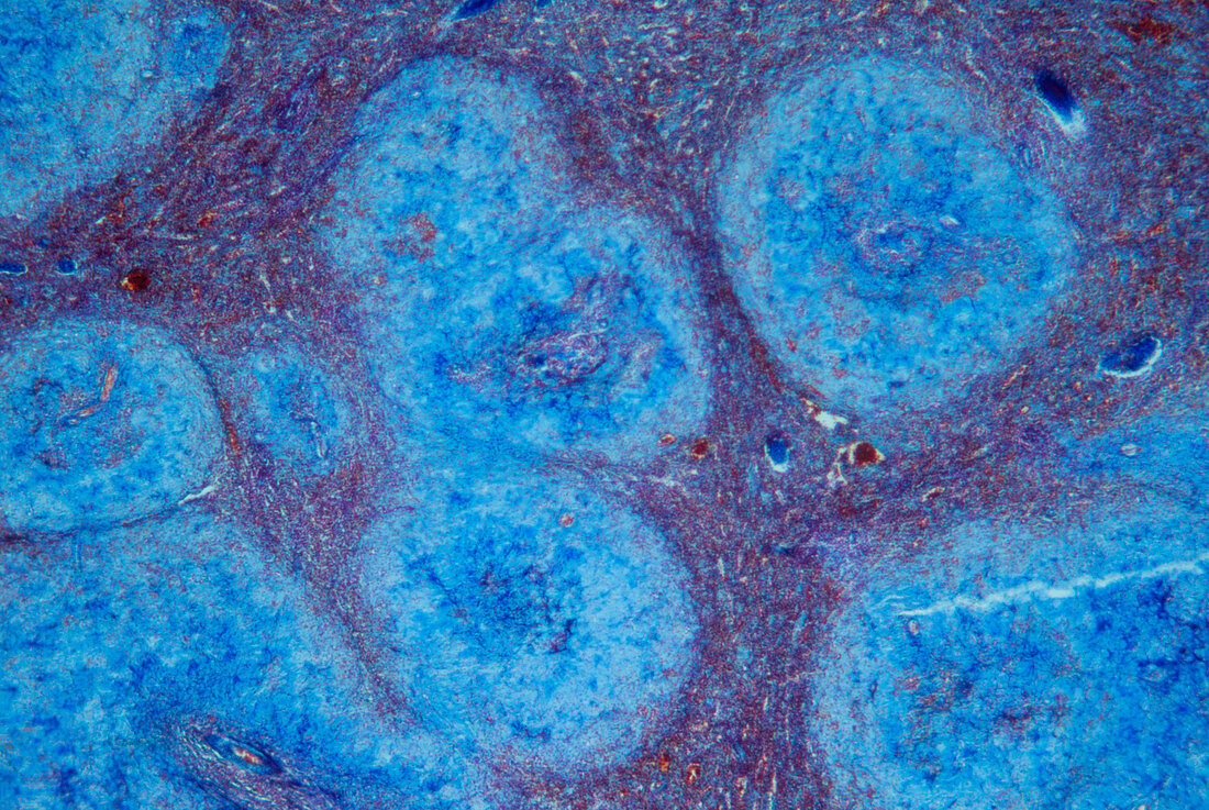 Light micrograph of amlyoidosis in spleen