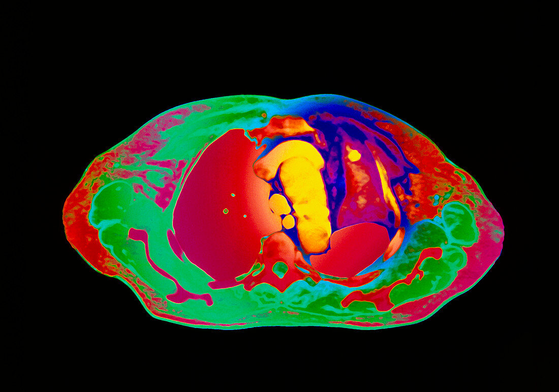 Coloured CT scan showing collapsed lobe of lung