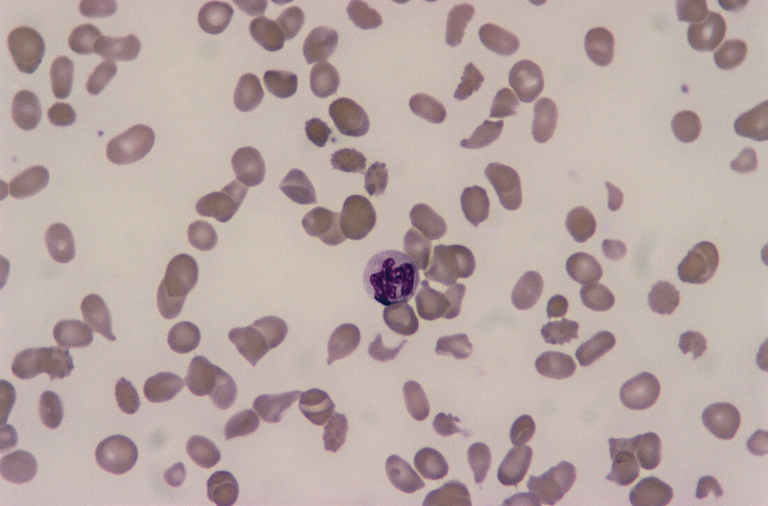 LM of a blood smear in pernicious anaemia