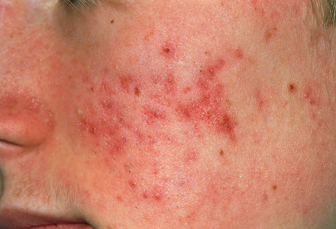 Acne vulgaris on cheek of 14 year-old boy
