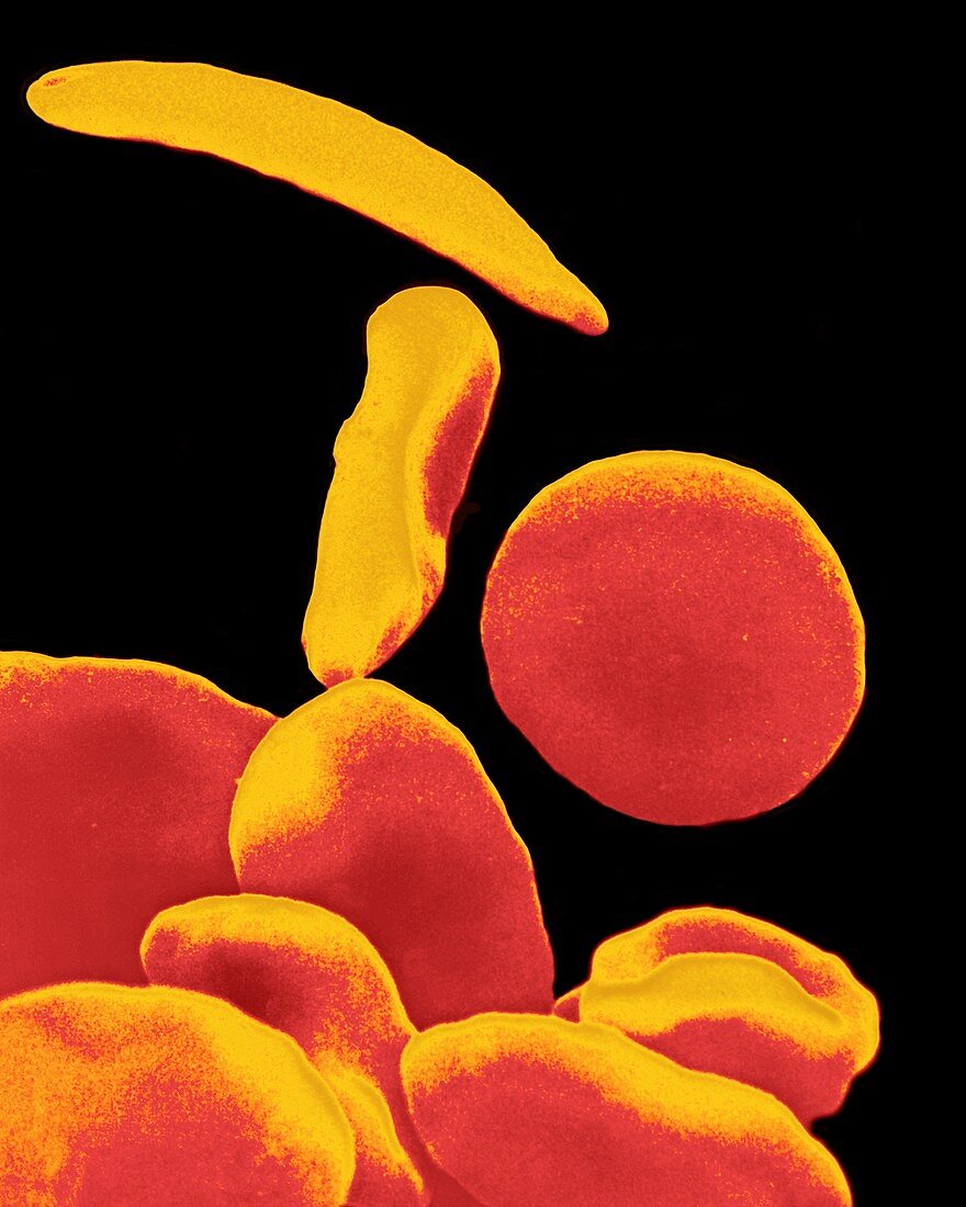 Coloured SEM of blood in sickle cell anaemia