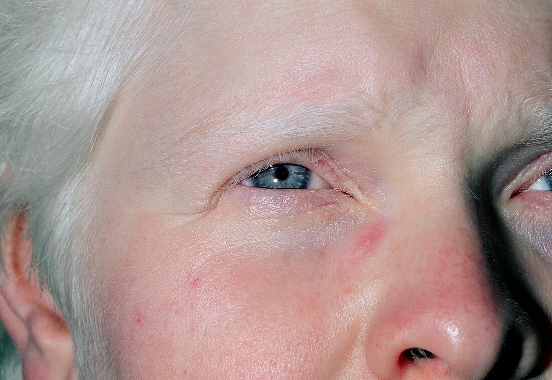 Face of an albino woman