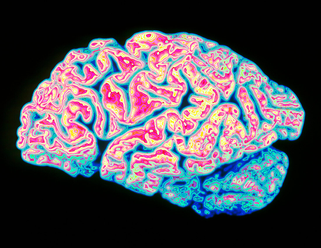 Computer-enhanced view of brain with Alzheimer's