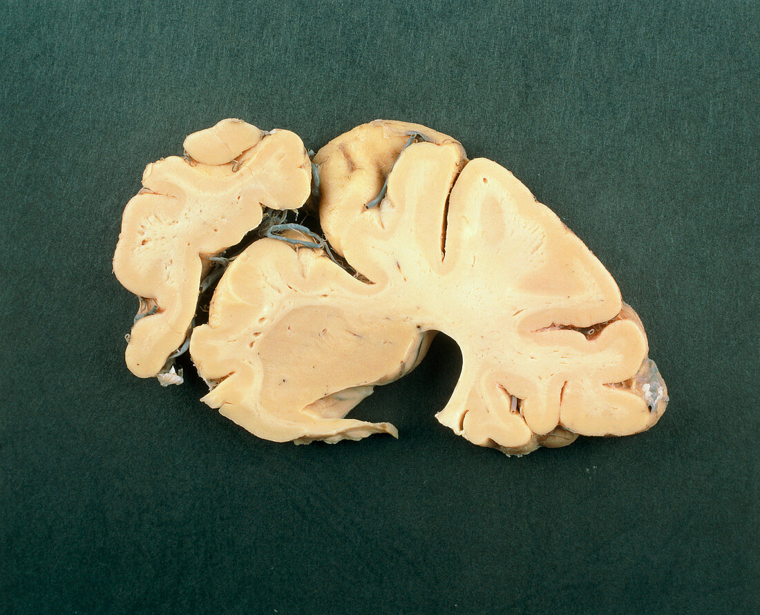 Slice of a brain affected by Alzheimer's