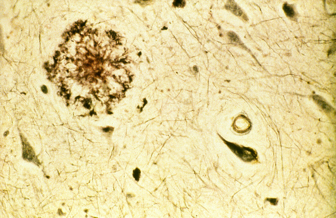 Brain tissue with Alzheimer's disease