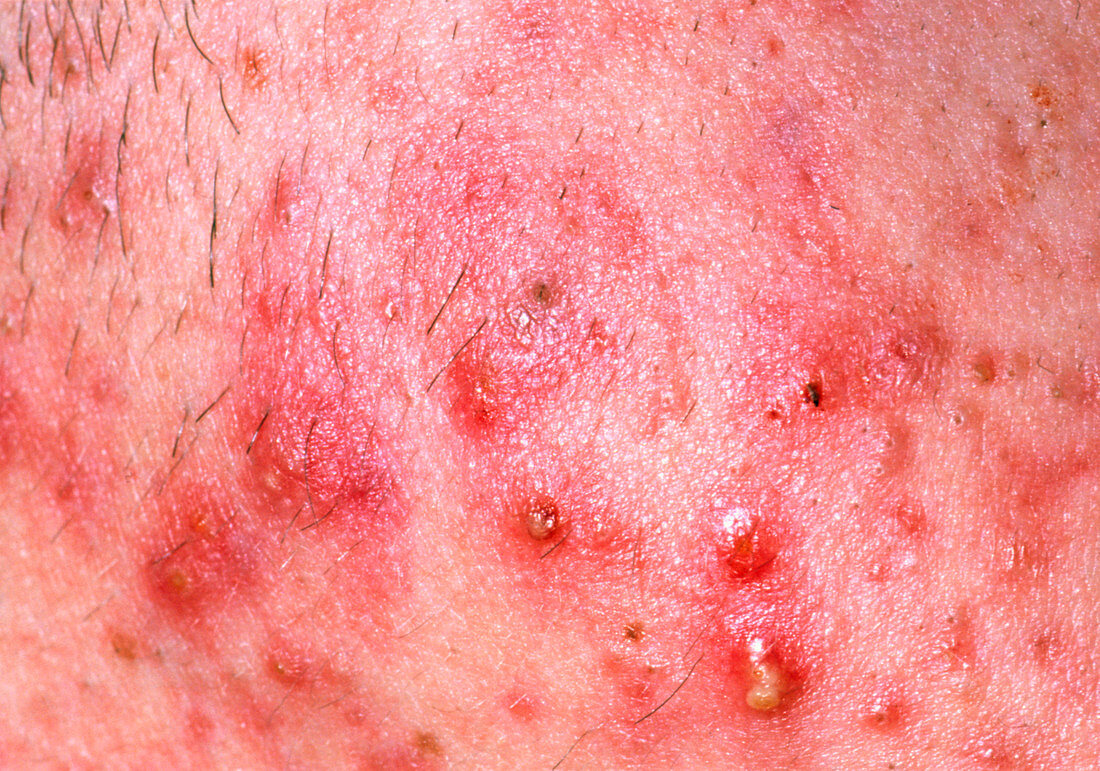 Acne vulgaris on the face of a young man