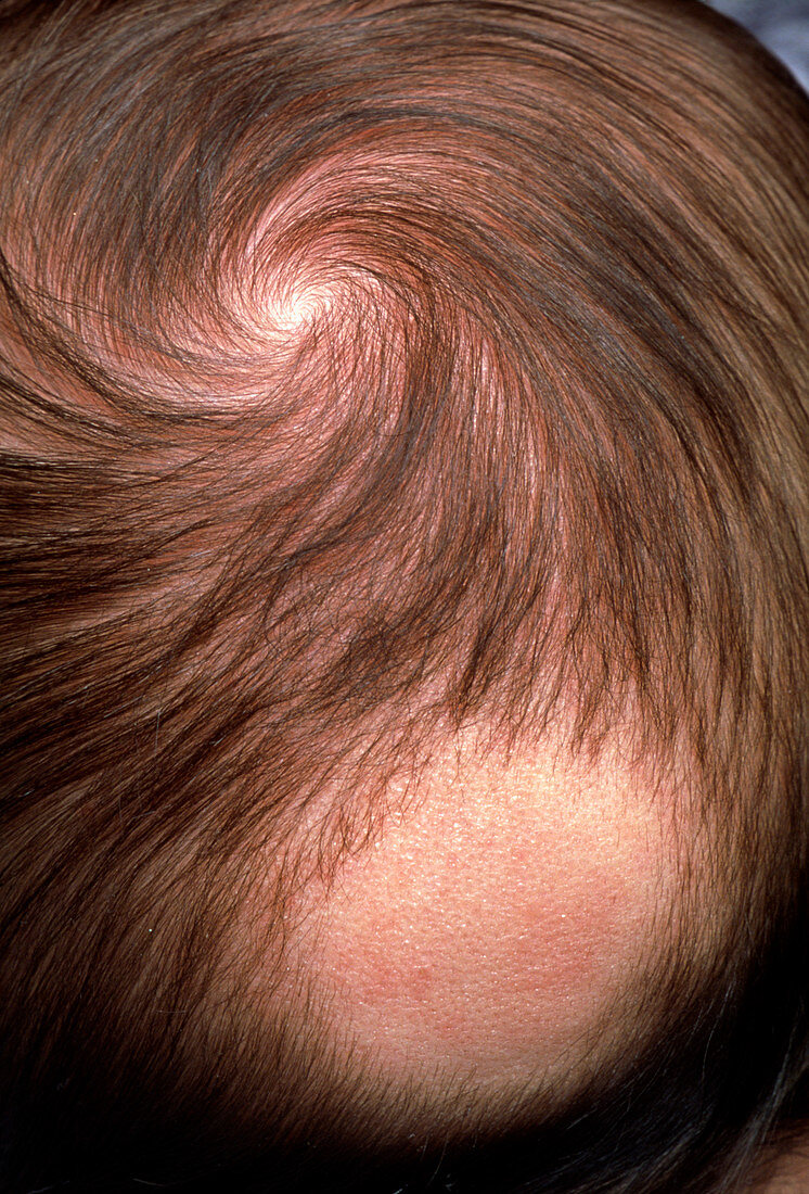 Bald patch on the back of 3 month old baby's head