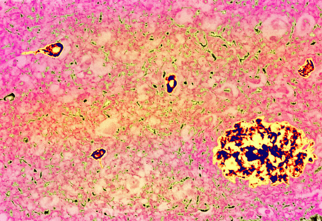 Coloured LM of Alzheimer's disease brain tissue