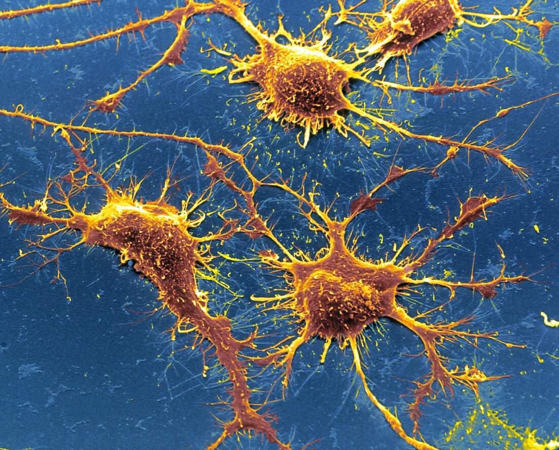 SEM of Alzheimer's disease culture cells