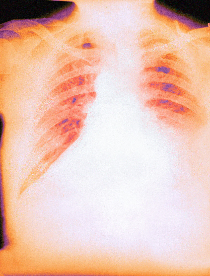 Pulmonary anthrax,X-ray